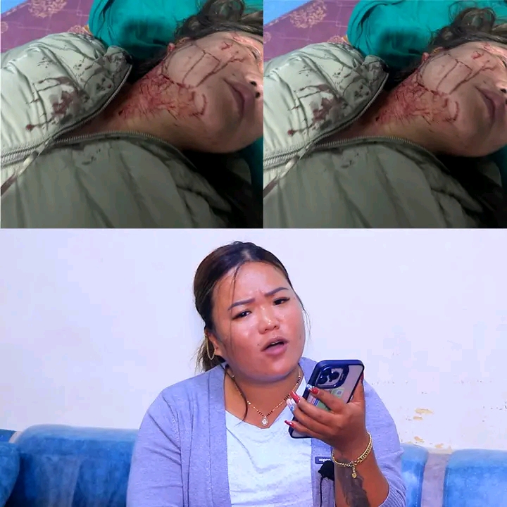 शर्मिला वाइबालाई रड प्रहार, स्तुपा अस्पतालमा उपचार हुँदै